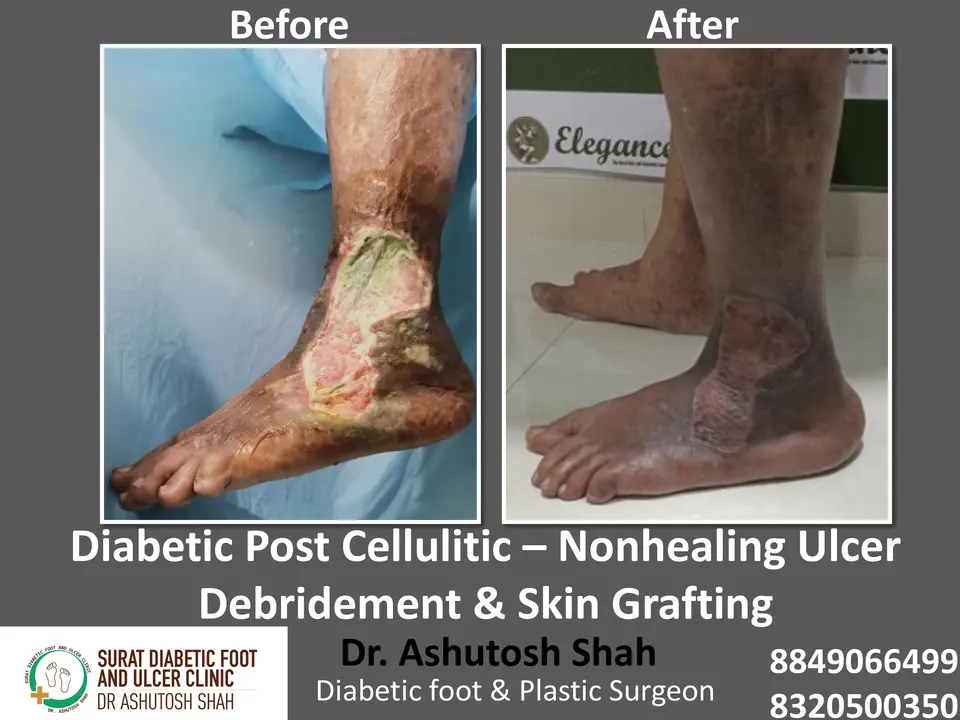 Diabetic Foot  PPT sunita.pptx-50.webp